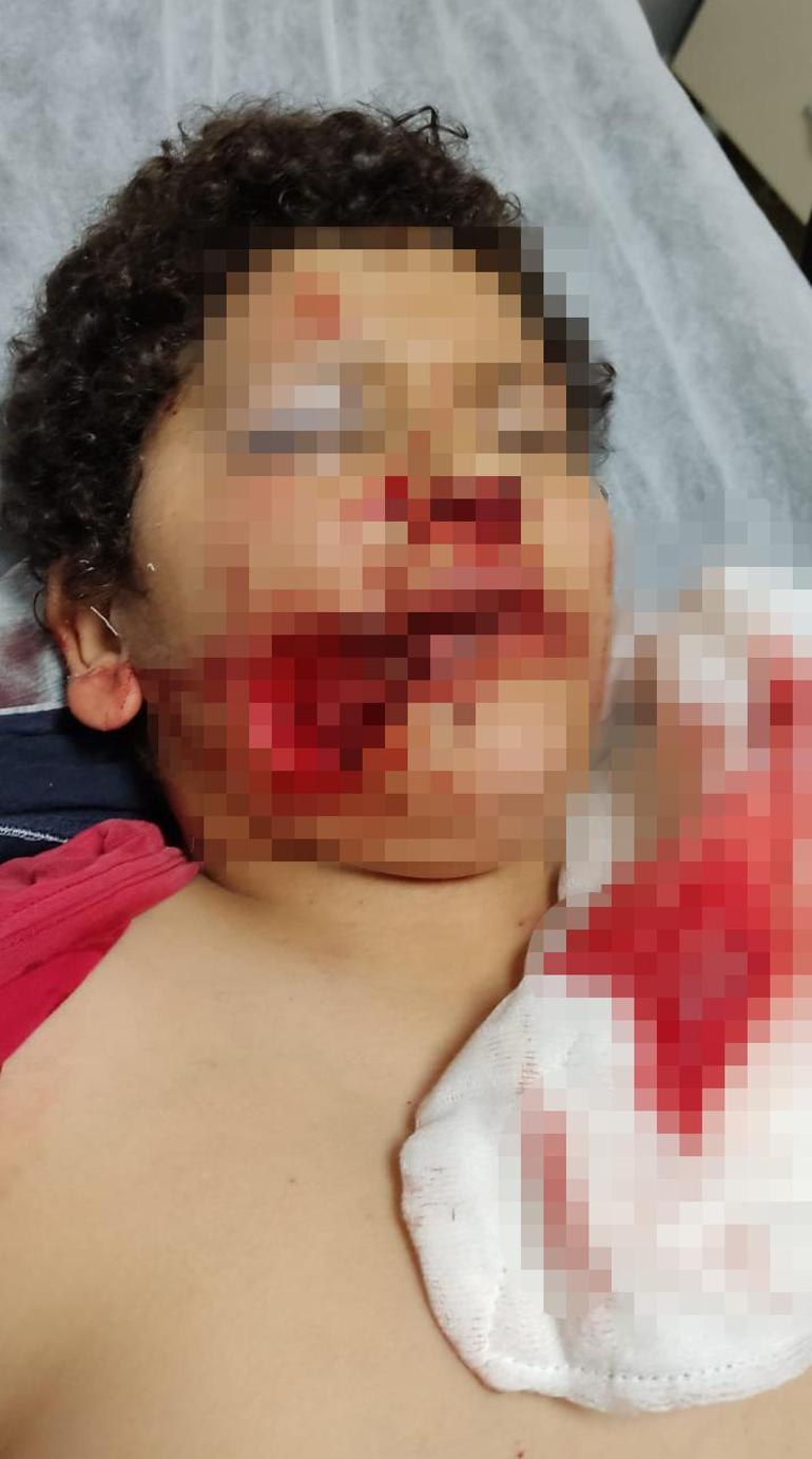 Yüzünden parça kopan Serdar, ambulans uçakla götürüldüğü Antalyada ameliyat edildi