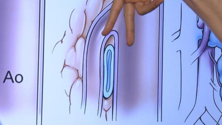 Fındıkkıran sendromu olduğu 14 yıl sonra ortaya çıkan hasta ameliyatla sağlığına kavuştu
