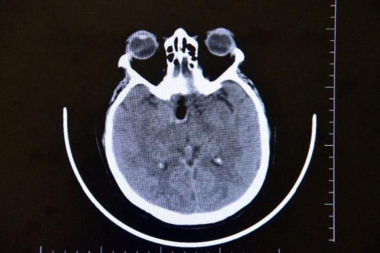 Beynindeki milyonda bir görülen tümör, ameliyatla alındı