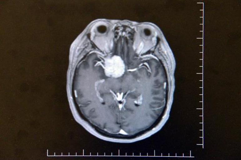 Beynindeki milyonda bir görülen tümör, ameliyatla alındı