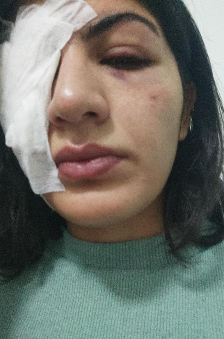 Motosikletten attıkları cisimle Hatice’yi gözünden yaralayan 2 şüpheli tutuklandı