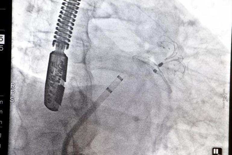 15 günde 2 kez felç geçirdi, operasyonla sağlığına kavuştu