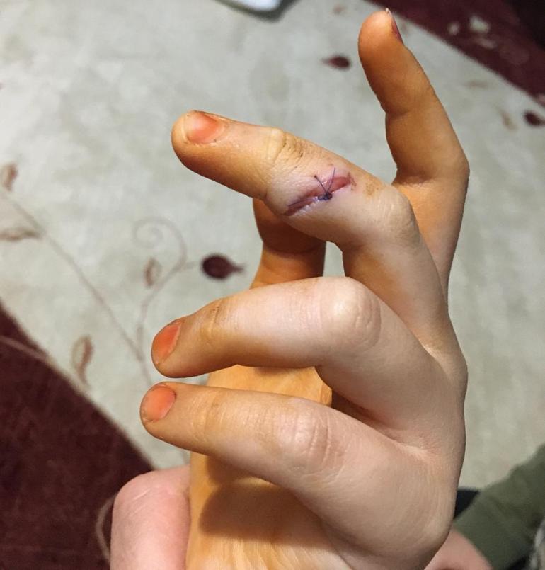 Köpeklerin saldırdığı Özge, yaralandı