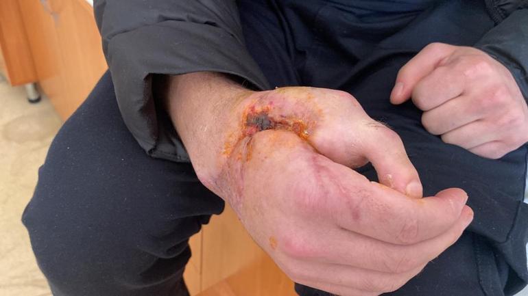 Kopan el parmağı yerine ayak parmağı dikildi