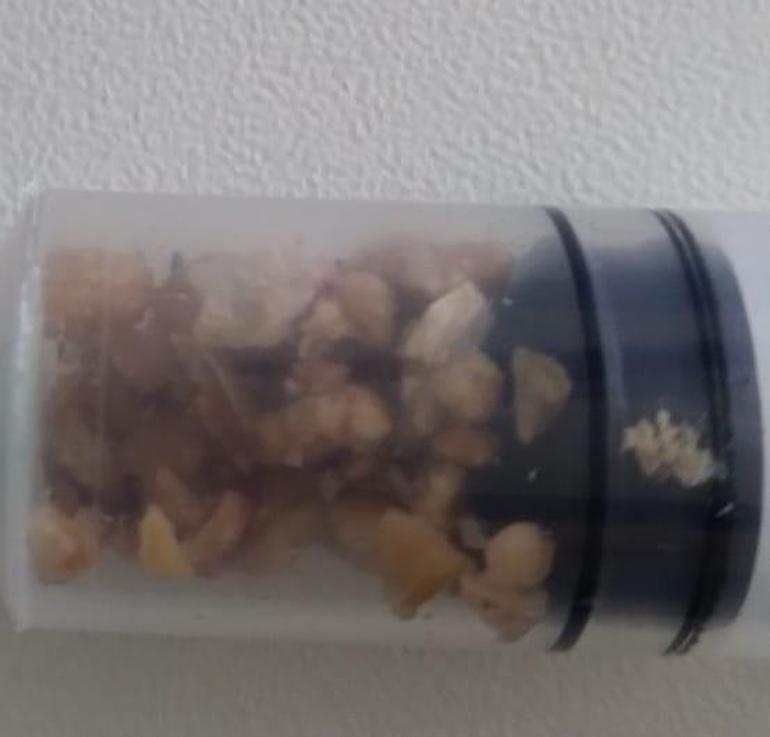 14 aylık Göktürkün böbreğinden 40 taş çıkarıldı