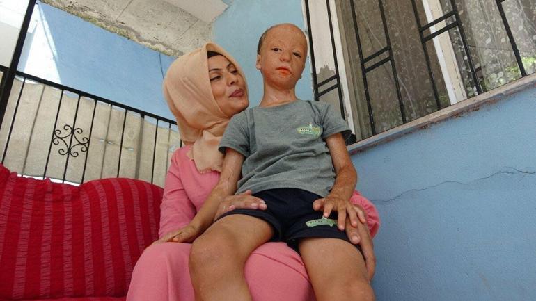 Yangında yaralanan 9 yaşındaki Halil, 3üncü kez doku nakli için bekliyor