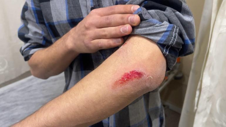 Otobüs beklerken köpeklerin saldırısına uğrayan üniversiteli yaralandı