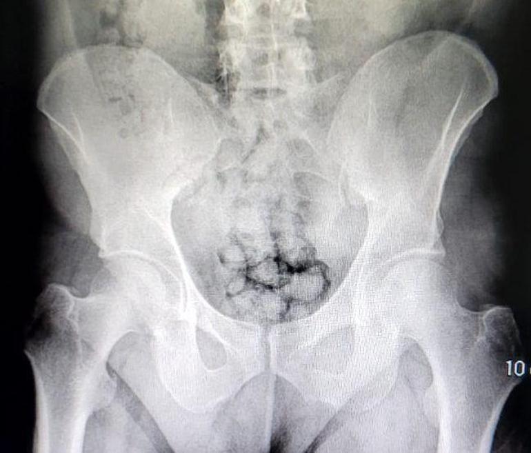 Midelerinde uyuşturucu taşıyan şüpheliler adliyede