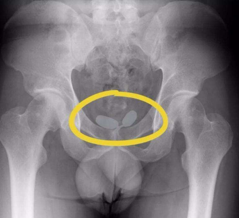 Havalimanında bedeninde uyuşturucu tespit edilen şüphelilerden 2si tutuklandı