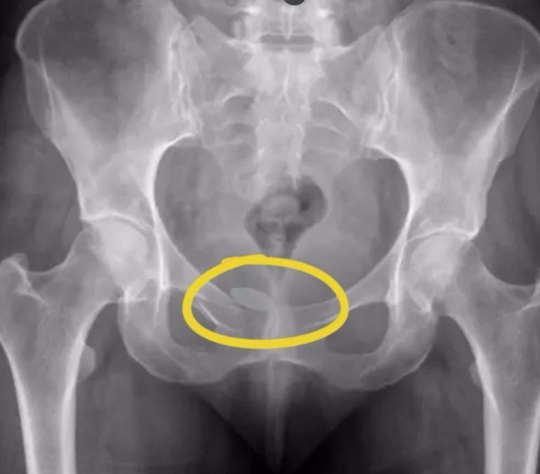 Havalimanında bedeninde uyuşturucu tespit edilen şüphelilerden 2si tutuklandı