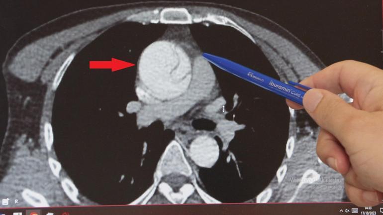 Mide ağrısı sandı, aort damarında yırtık çıktı