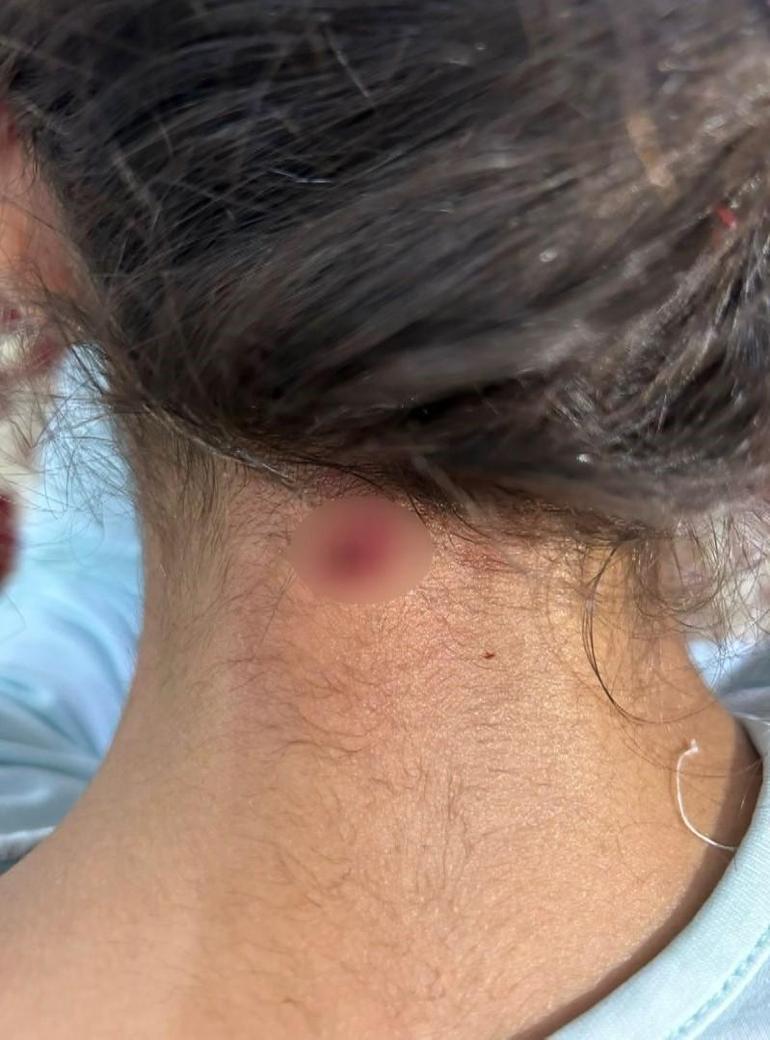 Bahçelievlerde maganda kurşunu 11 yaşındaki kızın boynuna isabet etti