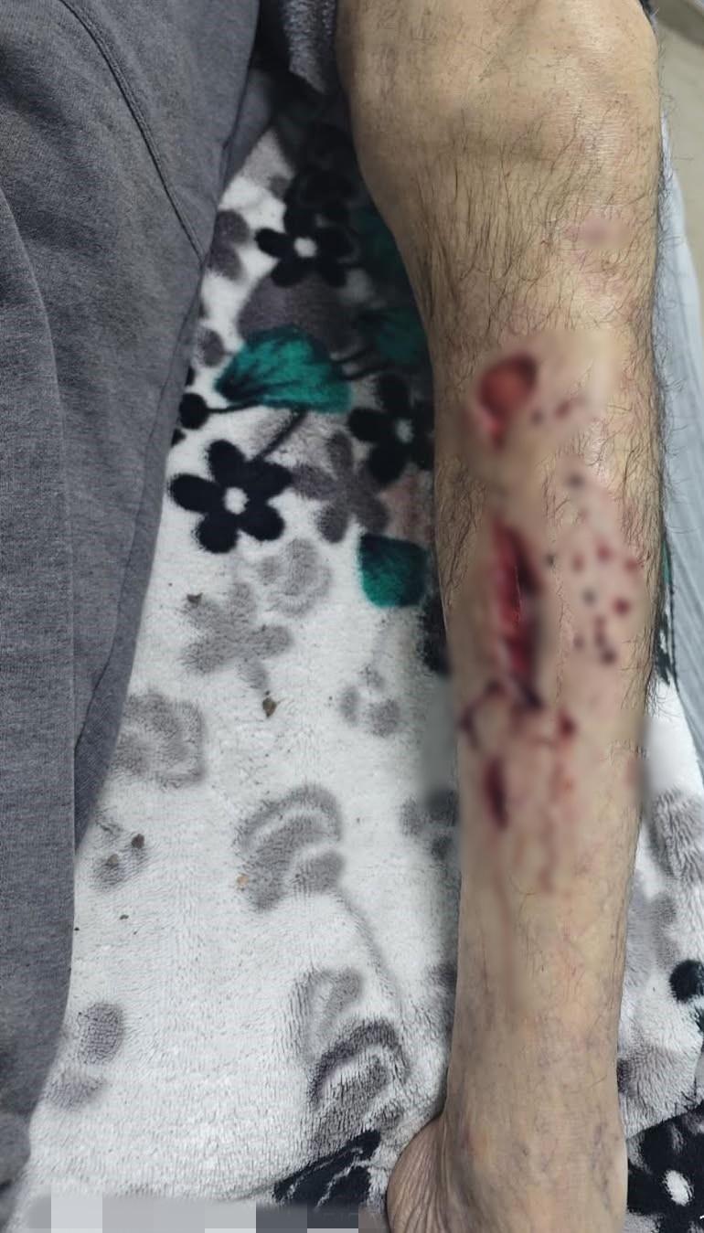 Sokak köpeğinin saldırısına uğradı, bacağına 25 dikiş atıldı