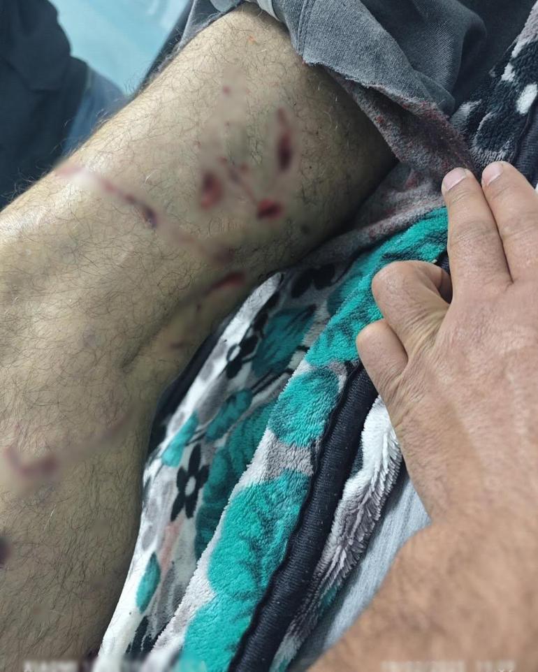 Sokak köpeğinin saldırısına uğradı, bacağına 25 dikiş atıldı