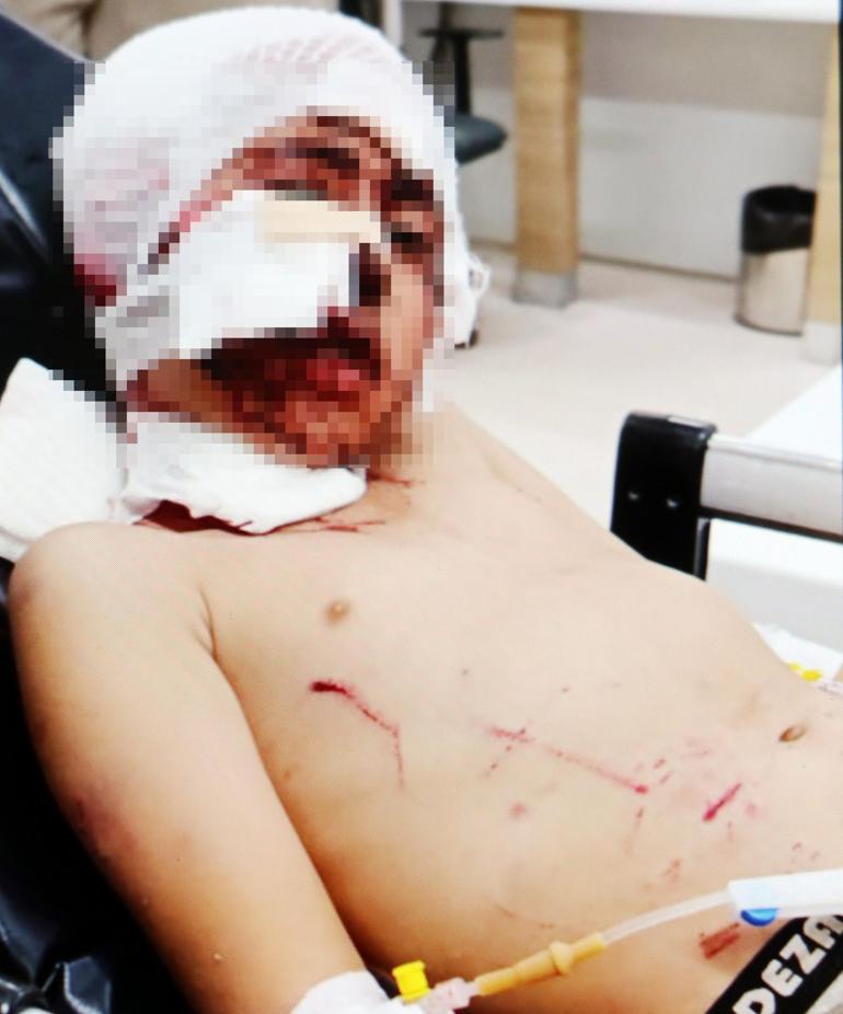 Bakkala giderken köpeklerin saldırısına uğrayan Murat, ağır yaralandı