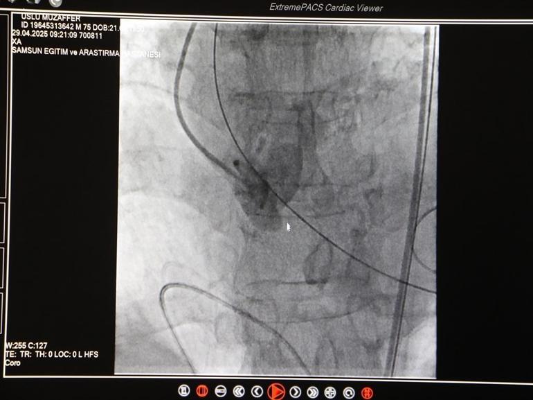 Türkiyedeki ilk, dünyadaki 18nci vaka; 4 yaprakçıklı aort kapağı olan hastaya TAVI ile operasyon