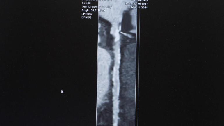 Prof. Dr. Özveren: Ani kalp ölümü her yaşta vurabilir