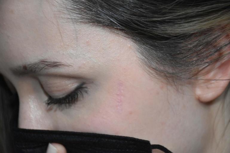 Komşusunun boynundan bıçakladığı Betül: Hala kabuslar görüyorum