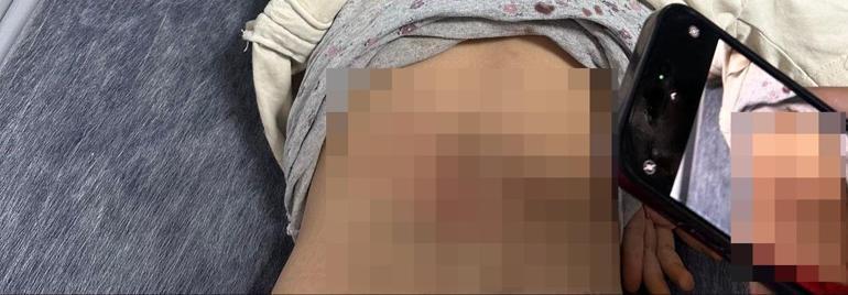 Sokak köpeklerinin saldırısına uğrayan Zeynep, yaralandı