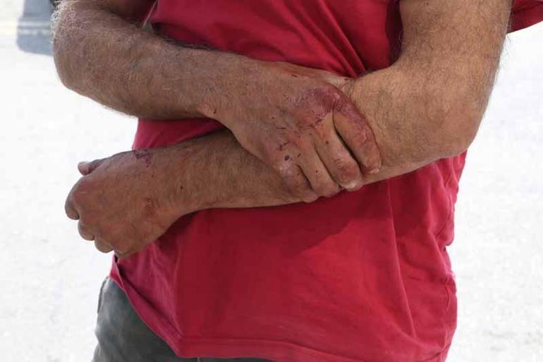 Kurban Bayramının ilk gününde acemi kasaplar hastanelere koştu