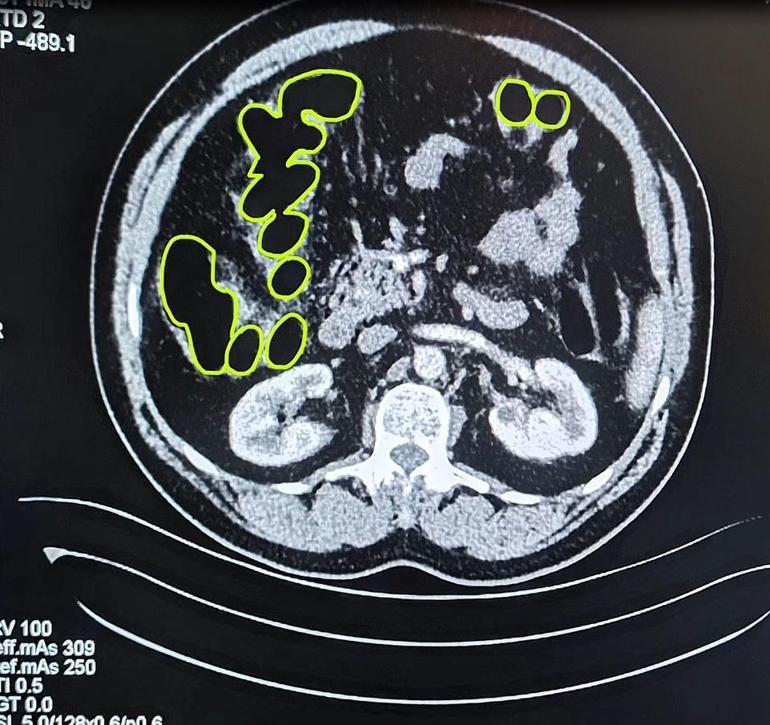 Kayseride, İranlı 3 şüphelinin midesinden uyuşturucu çıktı