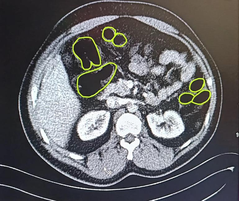 Kayseride, İranlı 3 şüphelinin midesinden uyuşturucu çıktı