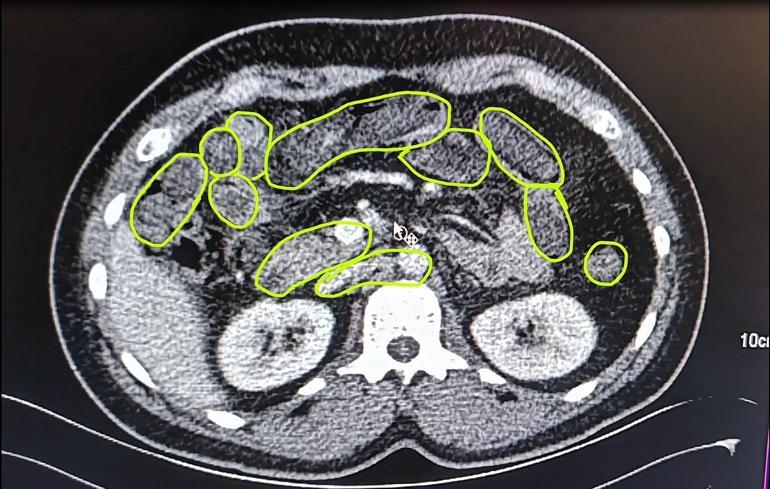 Kayseride, İranlı 3 şüphelinin midesinden uyuşturucu çıktı