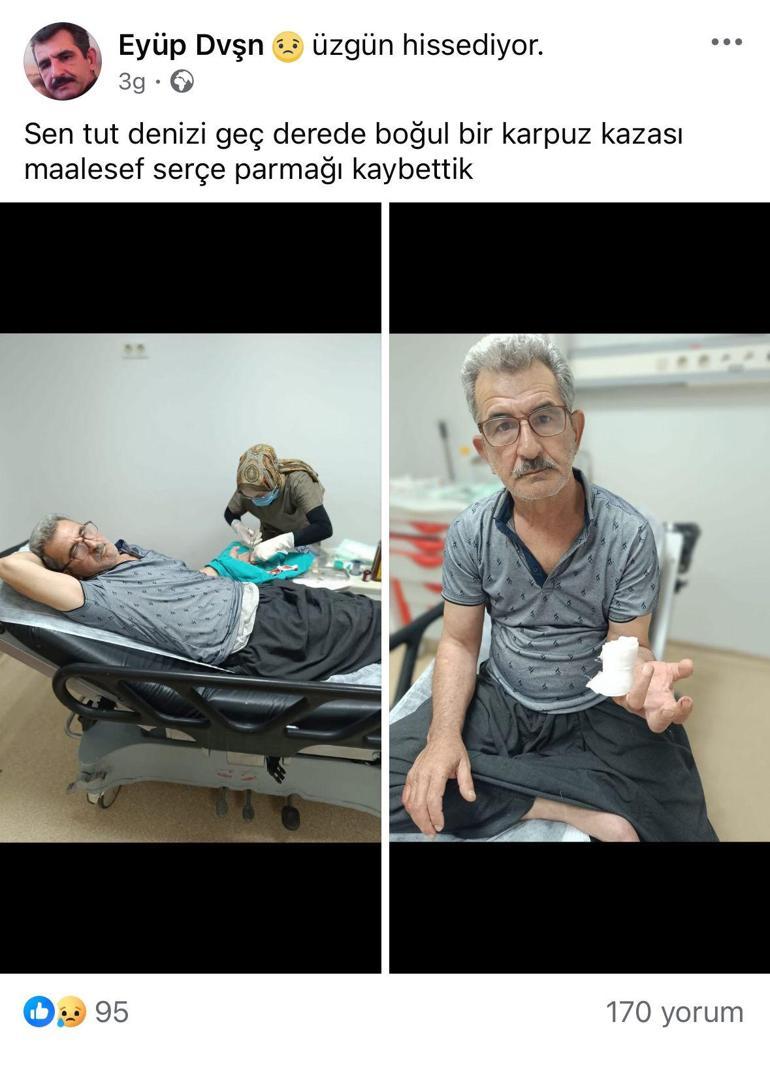 Karpuz keserken parmağını kesti
