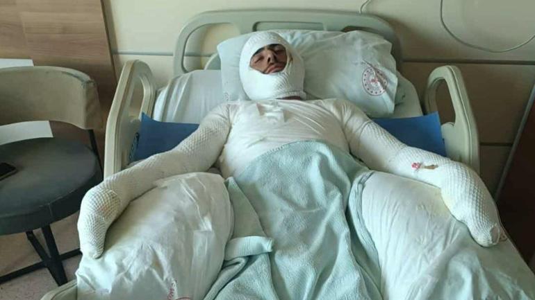 Şanlıurfada tarla yangını: 1i ağır 5 yaralı