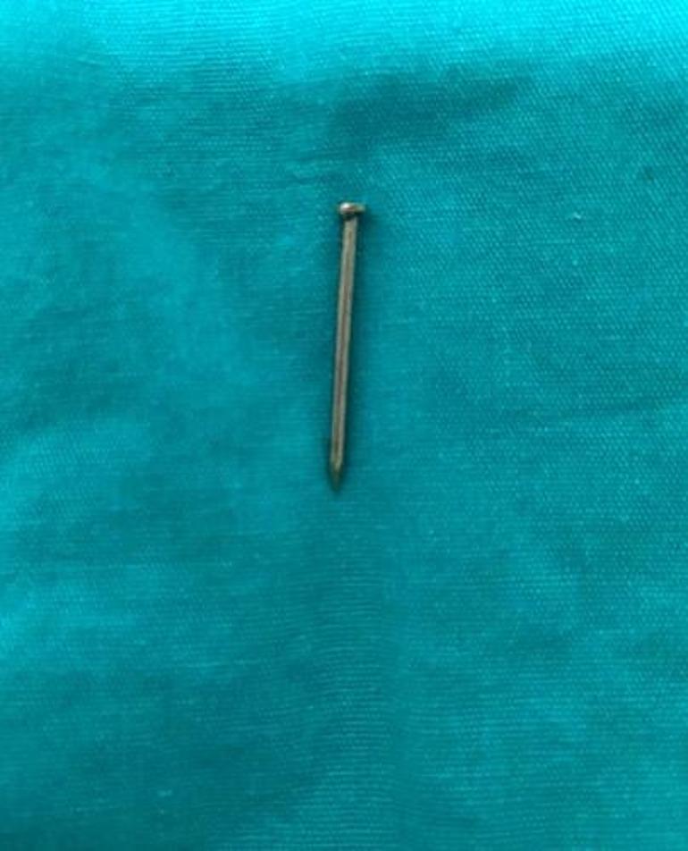 2 yaşındaki bebeğin yuttuğu çivi midesinden çıkarıldı