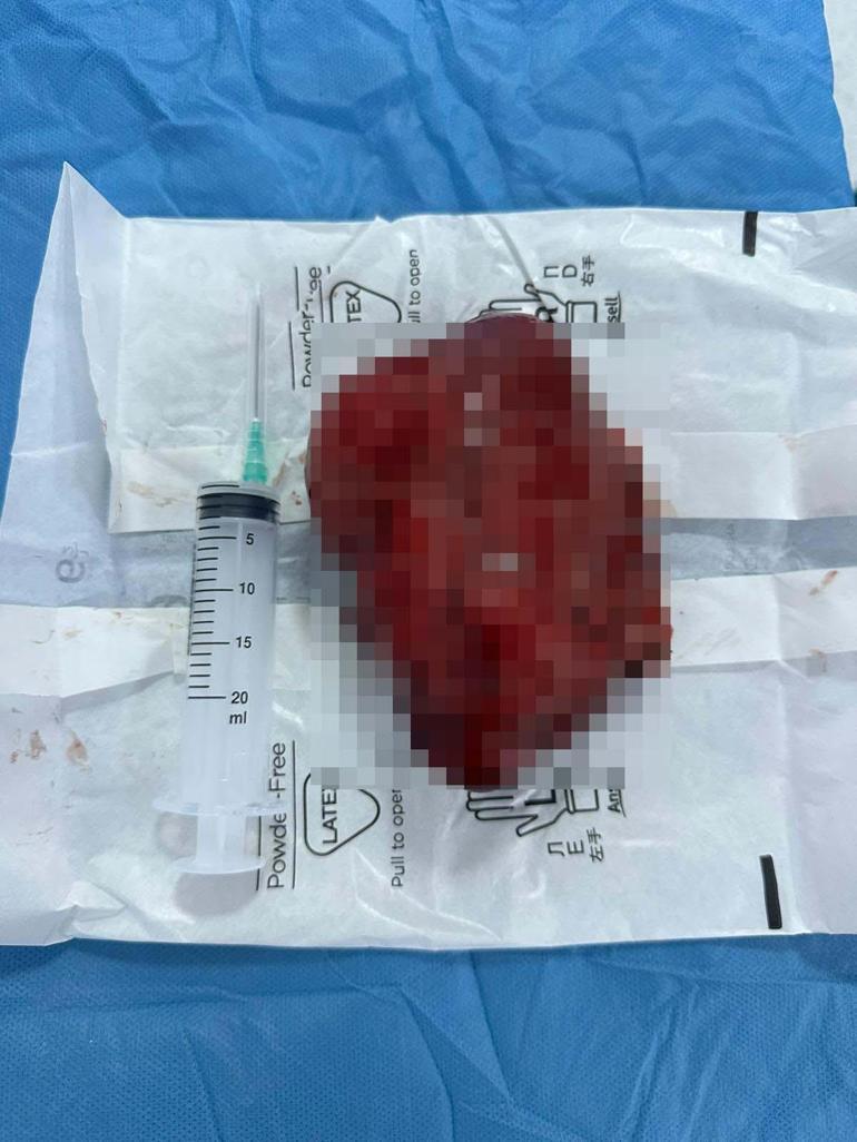 Kalbinin üzerindeki 2 kiloluk kitle ameliyatla çıkarıldı