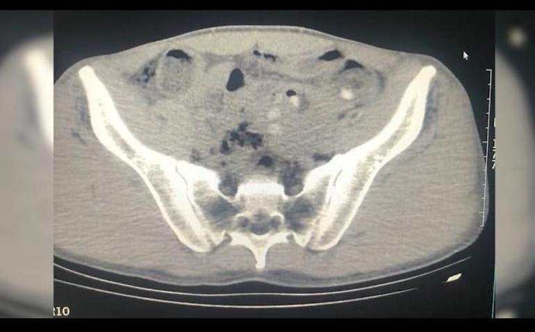 Midelerinde uyuşturucu ile yakalanan yabancı uyruklu 3 şüpheli tutuklandı