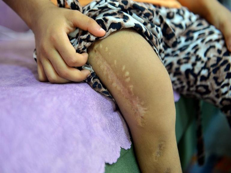 Sağ bacağı kısa dünyaya gelen Asel Ecrin, koşup, oynamak istiyor