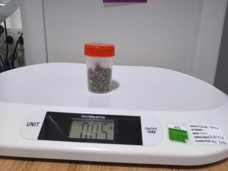 Bursada 77 yaşındaki kadının safra kesesinden 213 tane taş çıkarıldı