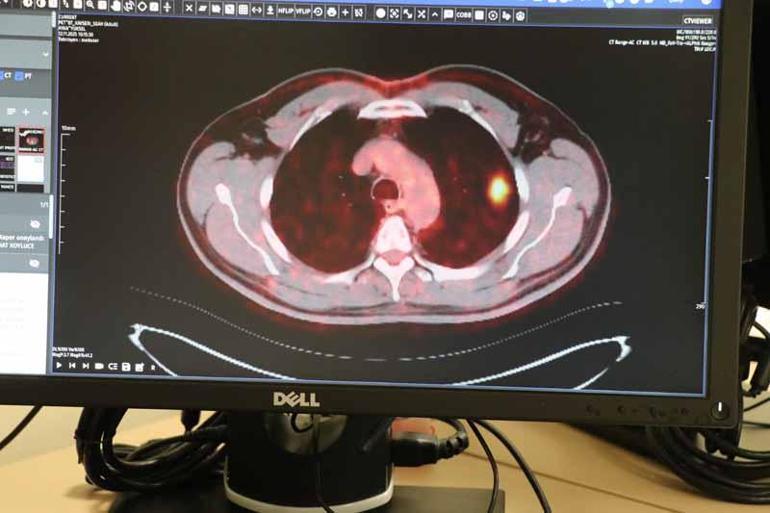 Akciğer kanserini yenen 50 yıllık sigara tiryakisi: 2 aydır adını anmıyorum