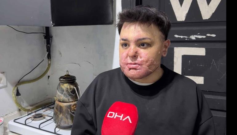 Kağıthane’de kuafördeki yangında vücudu yanan 15 yaşındaki Engin: Mücadeleyi kesinlikle bırakmasınlar ben yılmadım