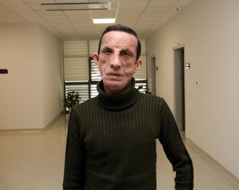 İlk yüz nakilli Uğur Acar, hayata 14 yıldır başka bir yüzle bakıyor