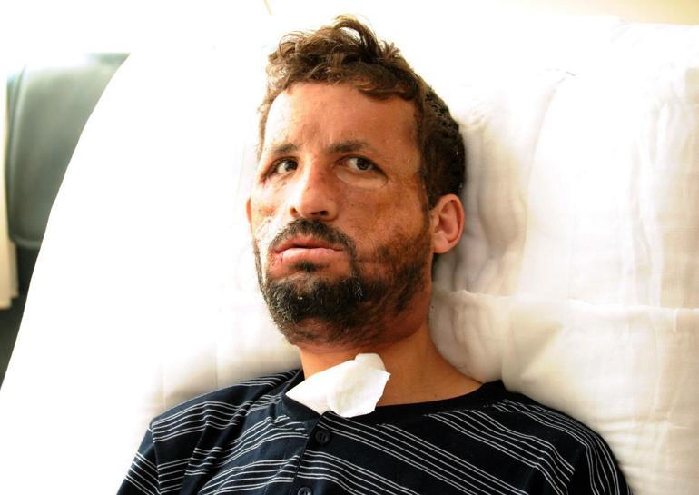 İlk yüz nakilli Uğur Acar, hayata 14 yıldır başka bir yüzle bakıyor