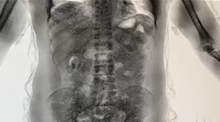 2025’te İstanbul Havalimanı’nda ‘yutucu’ kuryelerden 29,7 kilo uyuşturucu ele geçirildi