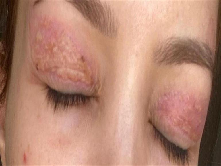 Gözünde hasar iddiasıyla yaptığı şikayet reddedildi; Uzmanına gidin uyarısı yaptı