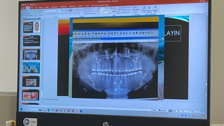 Ortognatik cerrahi ile hastalar hem çiğneme fonksiyonuna hem de estetik görünüme kavuşuyor
