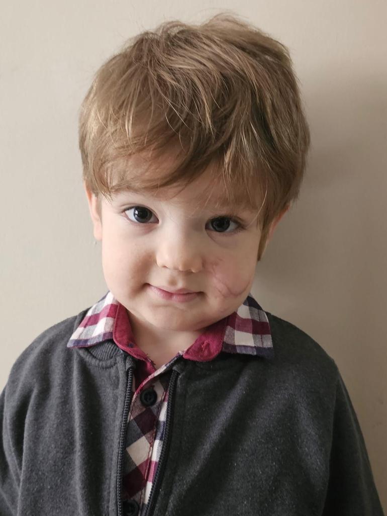 Pitbull saldırısında yaralanan kardeşlerin babası: Oğlumun yüzündeki yara kalıcı olacak gibi