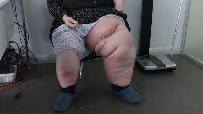 Fil hastalığı ile mücadele ederken yardım istemişti; 2 haftada ayağa kalktı