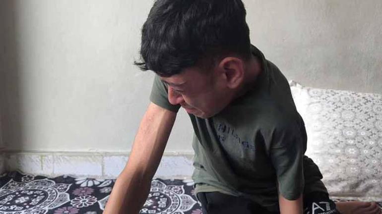 Skolyoz hastası Bünyamin, ameliyatla sağlığına kavuştu