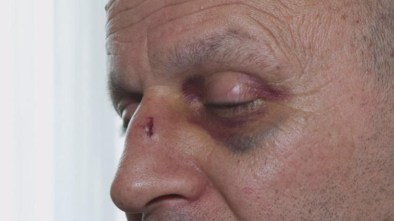 Başakşehirde kızıyla ekmek almaya giderken motosiklet çarptı: Ölebilirdim