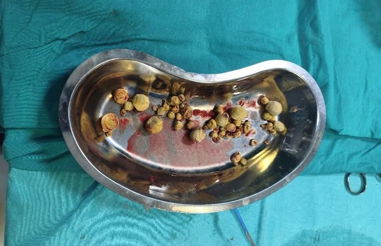 82 yaşındaki hastanın mesanesinden 42 parça taş çıkarıldı