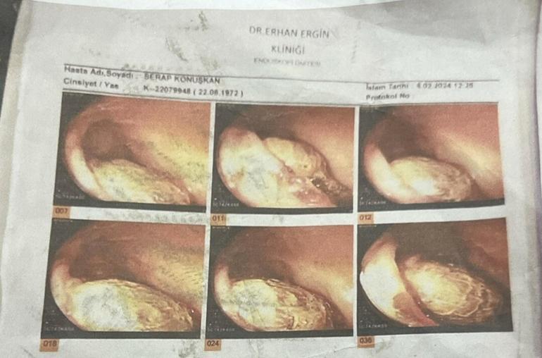 Ameliyatta gazlı bez unutulduğu iddiasıyla 2 doktor hakkında dava